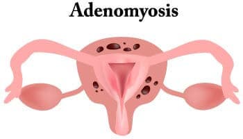 Adenomyosis Treatment – Top Fibroid Doctors & Specialists