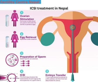 What is the ICSI treatment in Nepal & how is it performed?